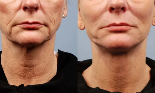 How much does Morpheus 8 cost per treatment in Vancouver