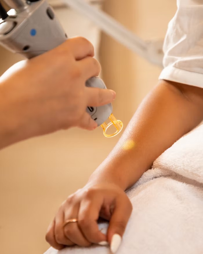Why Millennials and Gen Z Are Choosing Laser Hair Removal Over Waxing